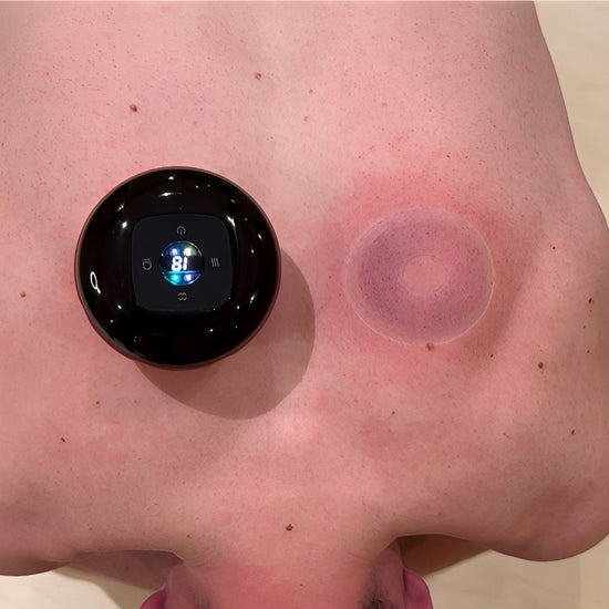 Cupping therapy marks from blood pooling