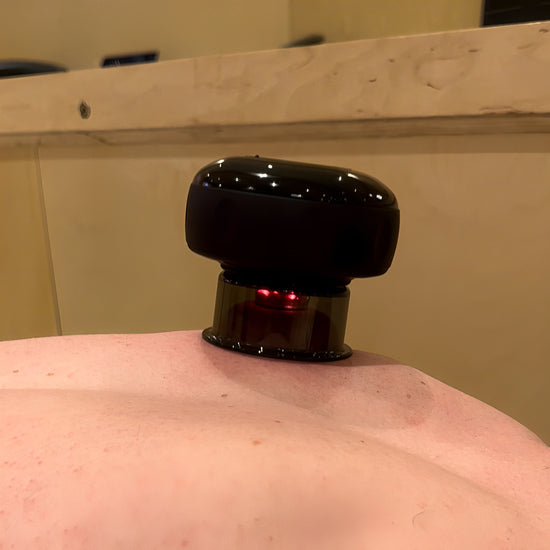 cupping therapy on the back for muscle relief 